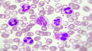 Eosinophil in Eosinophilic Granulomatosis with Polyangiitis illustration